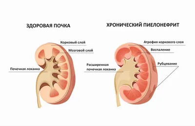 Малярные мешки: почему образуются суфы и как их убрать