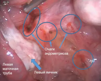 Эндометриоз: Боль, бесплодие и слёзы | Пикабу