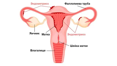 Наталия Травникова on Instagram: \"Выделения могут быть очень разные! В  разные периоды жизни и под воздействием внешних факторов. Например комки  могут быть при эндометриозе, при медицинском аборте, при выкидыше. Они так  же