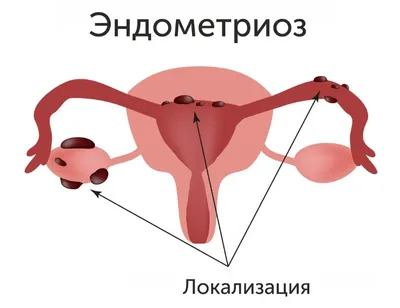 Эндометриоз - причины появления, симптомы заболевания, диагностика и  способы лечения