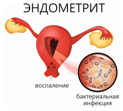 Наружный генитальный эндометриоз - причины, признаки и симптомы у женщин