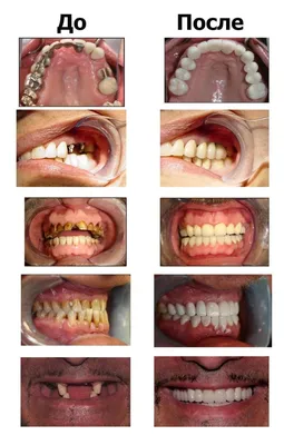 Металлокерамика зубы фото до и после