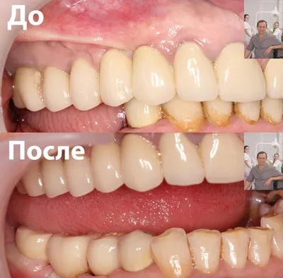 Металлокерамические коронки для зубов и их минусы: фото протезов от  Dominanta74