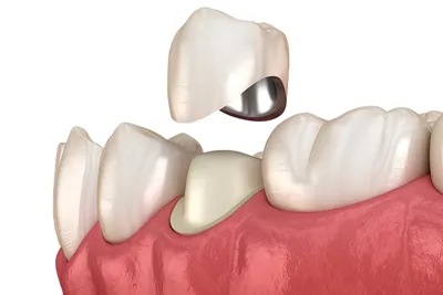 Коронки на зубах занизили прикус и разрушили другие зубы – клиника Smile  STD, Москва