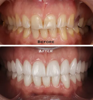 Металлокерамика - установка металлокерамических коронок в сети клиник  ЗубОК, лечение зубов