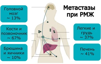 Метастазы в легких - диагностика и лечение