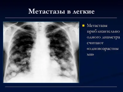 Метастазы меланомы - симптомы, причины появления, лечение