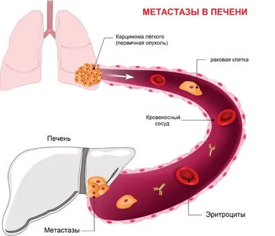 Рак груди. Метастазы в кости | История подавления метастазов