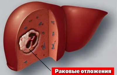 Метастаз беспигментной меланомы кожи в тонкую кишку. Клинический случай -  Журнал Доктор Ру