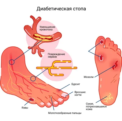 Сухая (твердая) мозоль