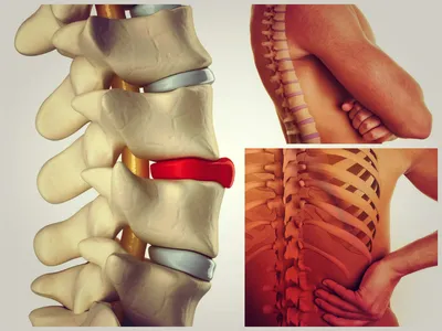 Симптомы, диагностика и лечение межпозвоночной грыжи - Стержень