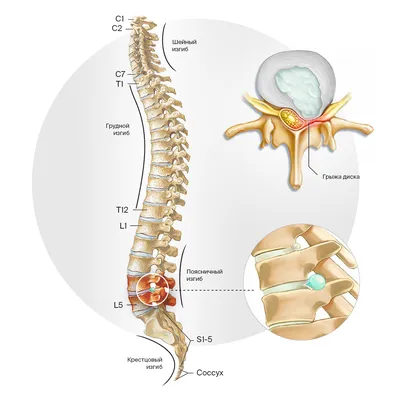 Грыжа межпозвоночного диска L5 S1 — симптомы, лечение без операции |  Клиника Ткачева