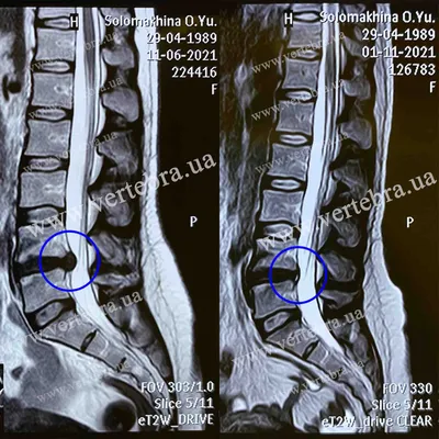 Межпозвонковая грыжа. Лечение грыжи позвоночника без операции в Киеве. -  Vertebra
