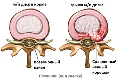 Межпозвонковая грыжа диска