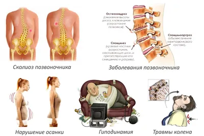 Грыжа межпозвоночного диска – выпячивание пульпозного ядра диска.