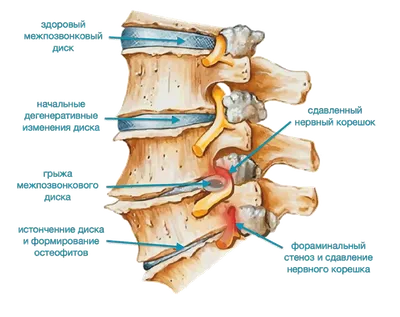 Понятие межпозвонковой грыжи