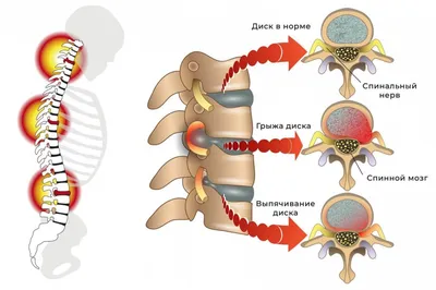 Современные методы диагностики грыж позвоночника