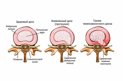 Чем протрузия отличается от грыжи? | Блог Клиники дискотерапии