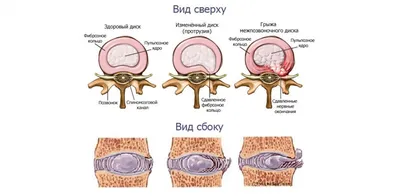 Мой позвоночник - Может ли межпозвоночная грыжа исчезнуть Большое число  людей, столкнувшихся с неприятными болями в пояснице или шее, задают  врачам-неврологам вопрос: может ли межпозвоночная грыжа исчезнуть?  Человеческое тело до 20-25 лет
