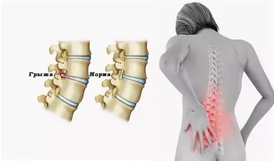 Лечение межпозвоночной грыжи в Смоленске – Стоимость услуги, запись на прием