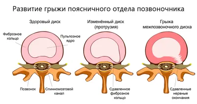 Межпозвоночная грыжа. Центр спины и суставов «Стамина»