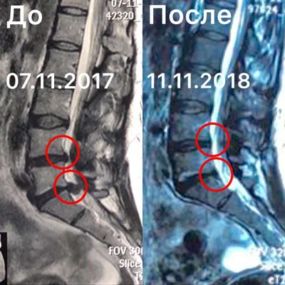 Межпозвоночная грыжа - диагностика и лечение в СЗАО (м.Щукинская,  м.Стрешнево, м.Сокол)