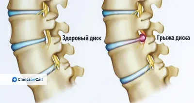 Как выбрать матрас при грыже позвоночника - советы от Матраскин.