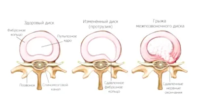Межпозвоночная грыжа - лечение и симптомы, диагностика | Клиника доктора  Длина