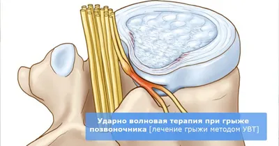 Грыжа межпозвонкового отдела - Доктор Позвонков