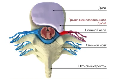 Межпозвоночная грыжа: симптомы, причины, диагностика, лечение | АО  «Медицина» (клиника академика Ройтберга)