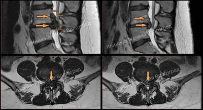 Межпозвонковая грыжа симптомы и лечение - центр «Остеопат»
