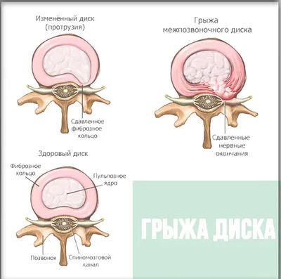 Найз - Программа здоровья - Межпозвоночная грыжа