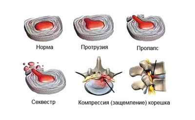 Секвестрированная грыжа позвоночника: симптомы, размеры, лечение,  последствия | Клиника Temed