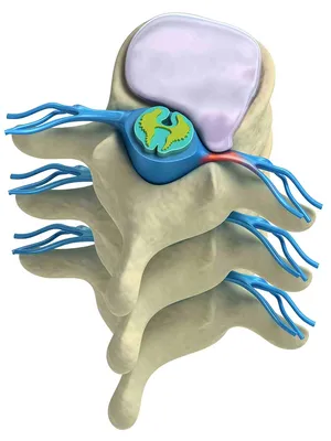 Скандинавский Центр Здоровья - Что такое межпозвоночная грыжа и почему она  появляется? ✓ Рассказывает врач-невролог Скандинавского Центра Здоровья  Анатолий Васильевич Каплун. Позвоночник — центральное звено  опорно-двигательного аппарата. Он состоит из ...