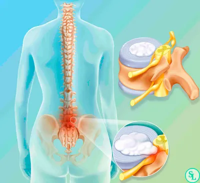 О методах лечения межпозвоночной грыжи. Мой опыт. | Пикабу