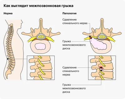 Межпозвоночная грыжа - лечение и симптомы, диагностика грыжи межпозвоночного  диска в Москве, Клинический Госпиталь на Яузе