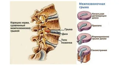 Болит ли межпозвоночная грыжа? - Доктор Позвонков