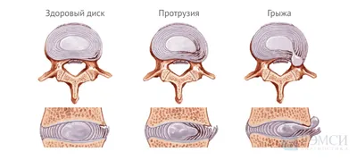 Грыжа межпозвоночного диска: причины, симптомы и лечение