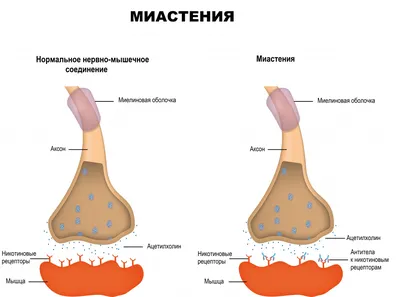 Миастения - причины появления, симптомы заболевания, диагностика и способы  лечения