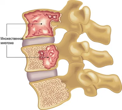 Миеломная болезнь - причины появления, симптомы заболевания, диагностика и  способы лечения