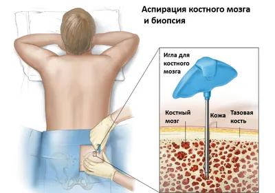 Множественная миелома | КлинКейсКвест