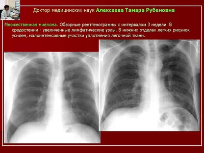 Множественная миелома - Влияние множественной миеломы на жизнь пациента  Множественная миелома, как и любое другое заболевание, вносит свои  коррективы в жизнь пациента. Своевременная специфическая терапия позволяет  улучшить качество жизни людей с ...