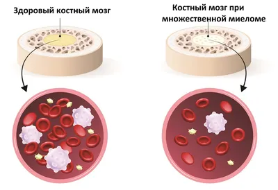 Лечение множественной миеломы в Германии — Методы и новые схемы лечения  миеломы в клинике «Нордвест»