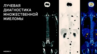 История из моей практики. Множественная миелома. | ЖИЗНЬ ПОСЛЕ МОРГА 🤔 |  Дзен