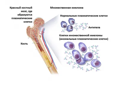 Множественная миелома | КлинКейсКвест