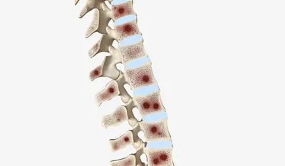 РНК-дефекты связаны с прогрессированием множественной миеломы - hematology  - mobile.Labmedica.com