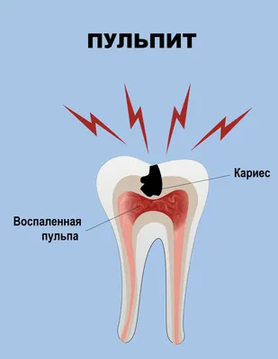 ПРОЯВЛЕНИЯ ВИЧ В ПОЛОСТИ РТА