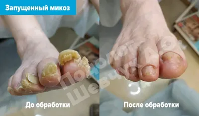 Чем опасен грибок | Блог Daily Medical