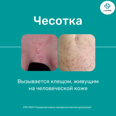 KAMINSKYI CLINIC on Instagram: \"Микроспория Грибковое заболевание кожи и  волос. Проявляется на коже в виде розовых кругов (колец) с приподнятым  краем по периферии. Может шелушиться, зудеть. Микроспория имеет склонность  к увеличению в