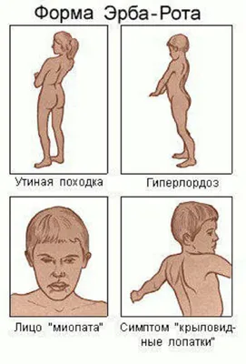 Миопатия - что это такое и как не проспать данный недуг? | Нервы в порядке  | Дзен